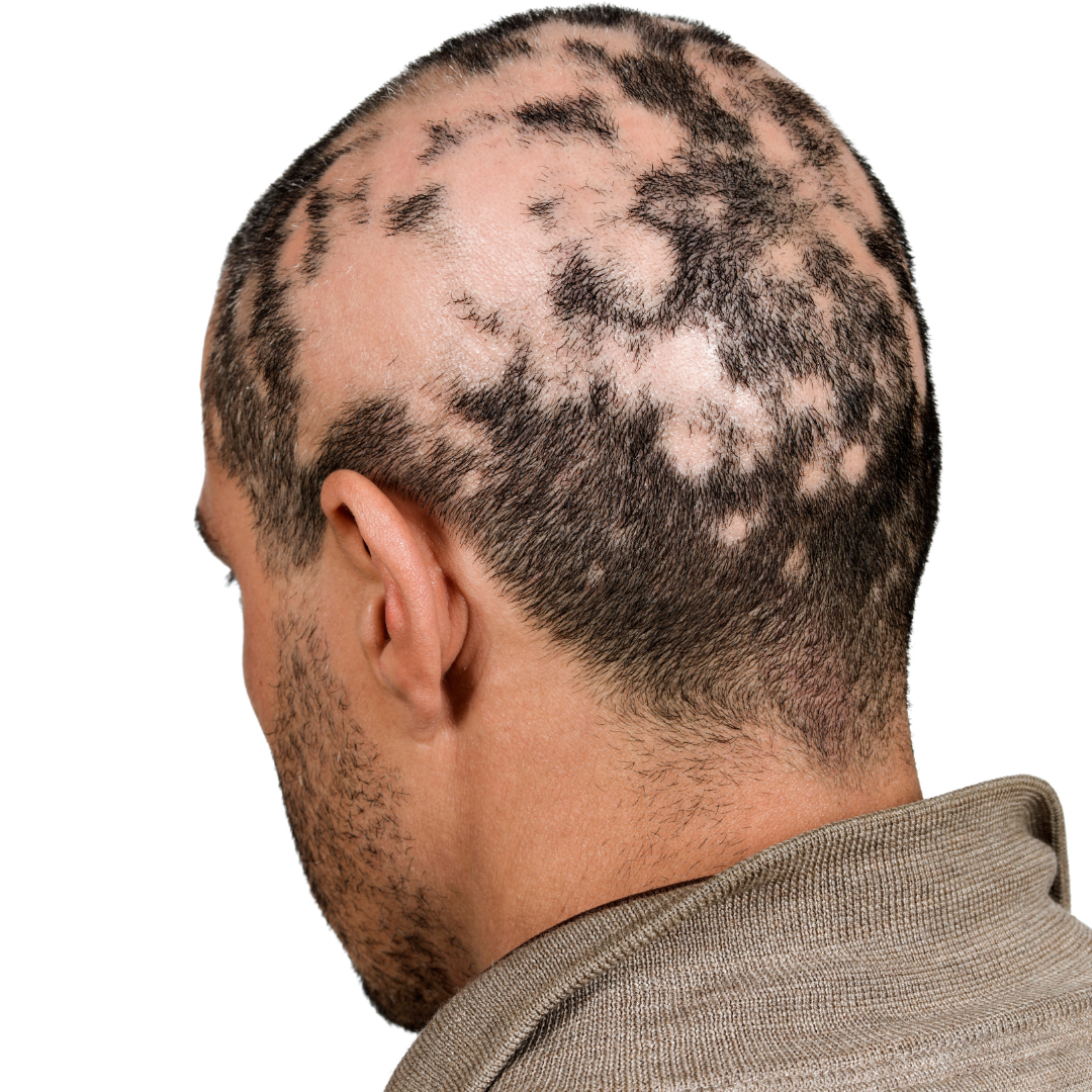 alopecia