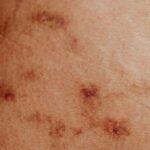 psoriasis