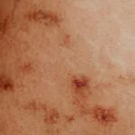 psoriasis